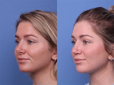 nose piercing after rhinoplasty|nose repierced after rhinoplasty.